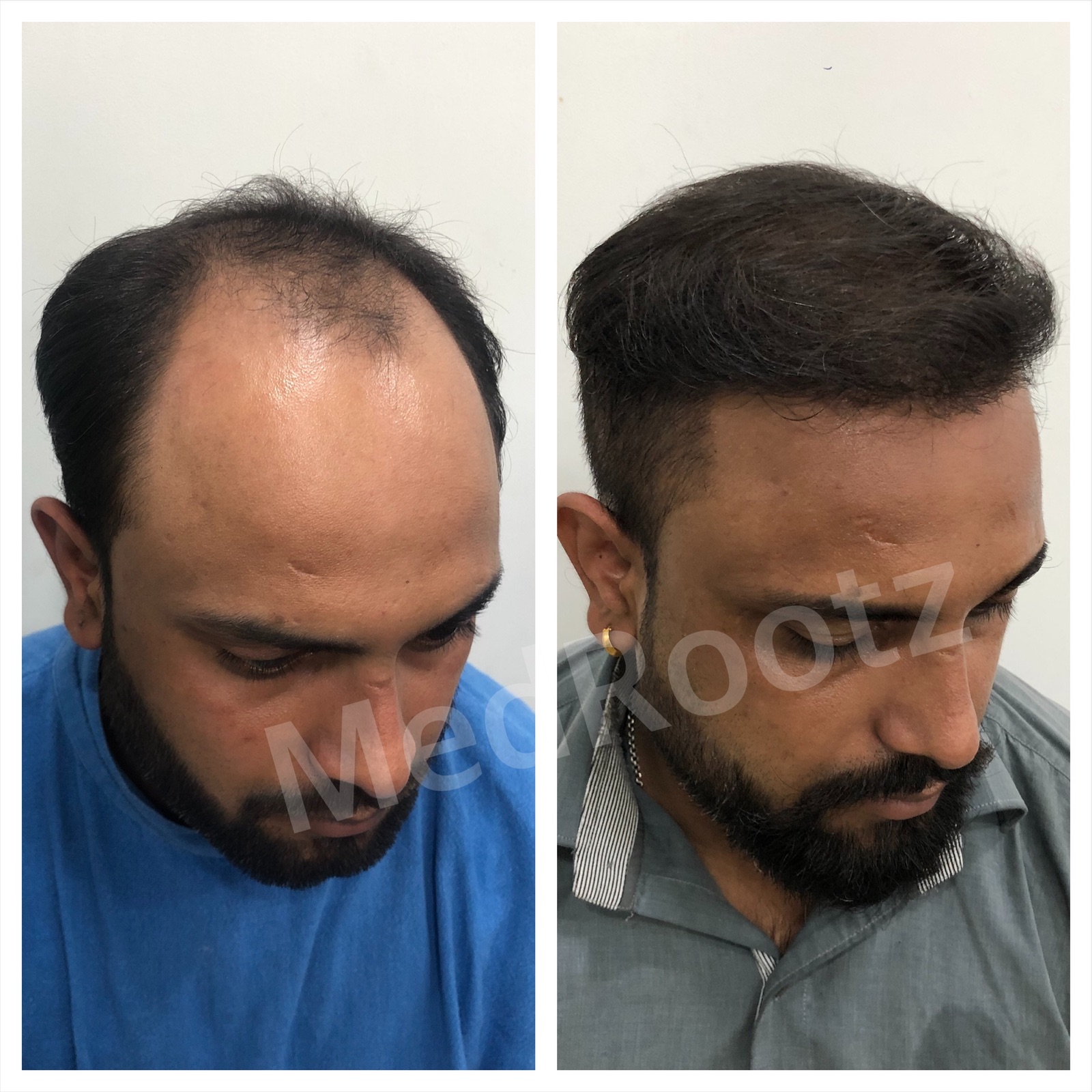 Best Hair Transplant clinic in delhi